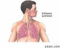 Se identifica un mecanismo responsable del enfisema pulmonar y la bronquitis crónica